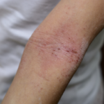 eczema