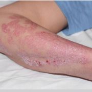psoriasis 600x400